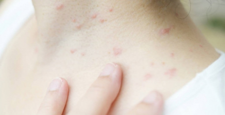 Doenças da pele autoimunes e o potencial da aplicação de intervenções mais precoces
