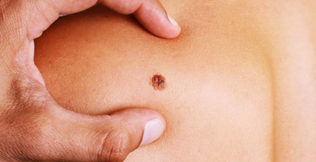 Um em cada cinco melanomas ficou por diagnosticar no ano passado