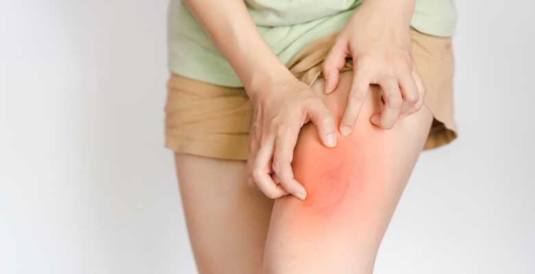 Urticária espontânea crónica afeta mais a qualidade de vida que dermatite atópica e psoríase