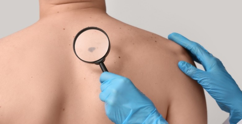 PlenoISLA: avanços em IA potenciam o diagnóstico precoce do melanoma em Portugal