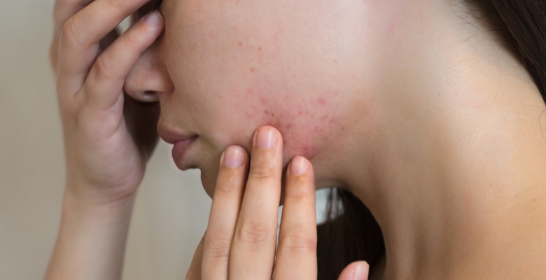 Acne vulgar e o seu impacto psicossocial oculto: depressão, ansiedade e padrões alimentares disfuncionais