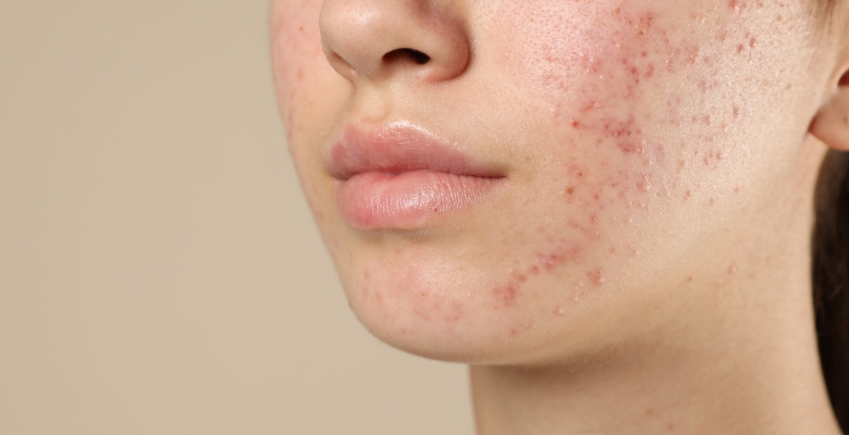 EuroGuiDerm lançou novas recomendações europeias para o tratamento da acne