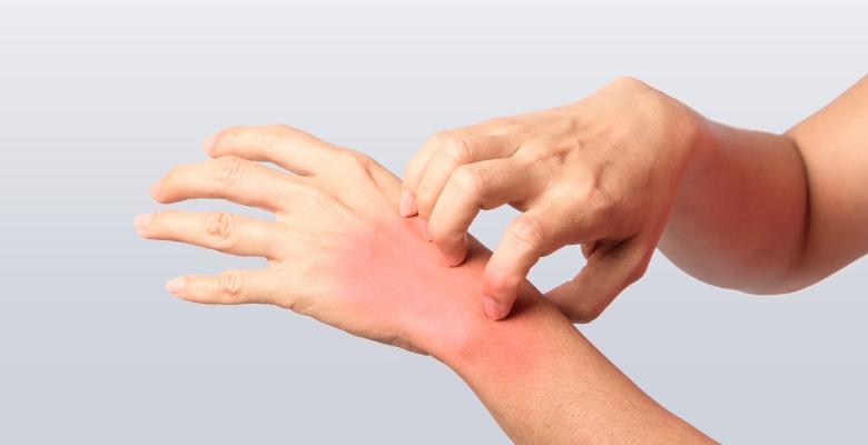 Dermatite alérgica de contacto: a maior causa de eczema crónico das mãos em Portugal