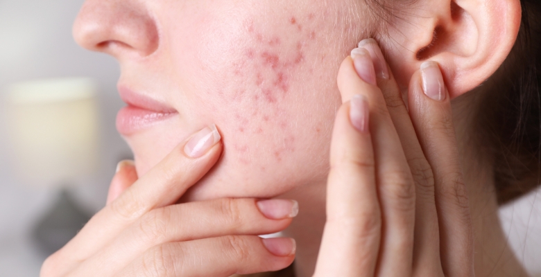 Variabilidade na prescrição de medicamentos levanta desafios no tratamento da acne