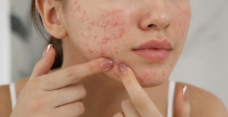 Eixo intestino-pele: disfunção intestinal associada à gravidade da acne