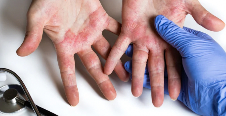 Fenómeno “flip-flop”: transição entre psoríase e dermatite atópica exige reconhecimento clínico