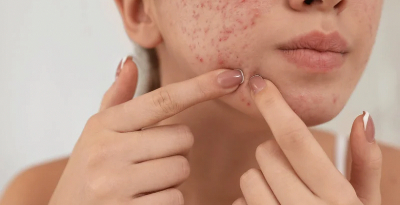 Stress, má qualidade do sono e estilo de vida ao aumento do risco de acne em estudantes universitários