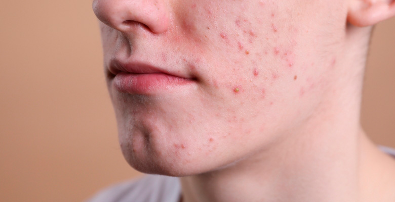Estudo identifica alterações no microbioma da pele associadas à gravidade da acne