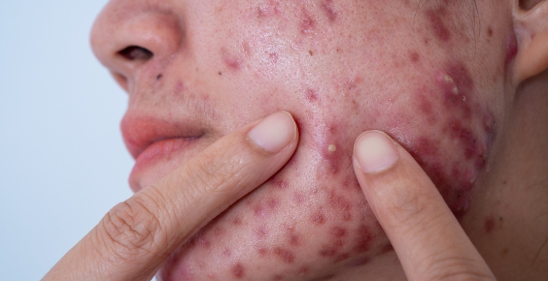 Inteligência artificial e nanopartículas podem abrir caminho a novo tratamento para o acne