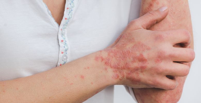 Autocompaixão como fator protetor na saúde mental em doenças dermatológicas